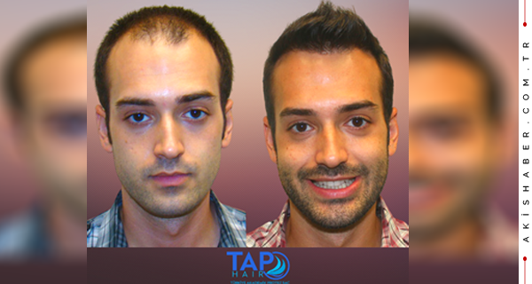 Tap Hair Esintisi; Protez Saç İle Yeni Bir Sayfa Açmaya Hazır Olun