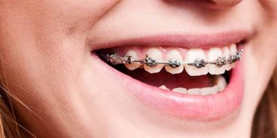 Balıkesir Ortodonti Tedavisinde Konforun ve Estetiğin Yeni Adı Dent266 